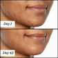 U.F.O. product usage, before and after results from day 1 to day 42 on dark skin. Clear and visible results; reduced redness and blemishes.